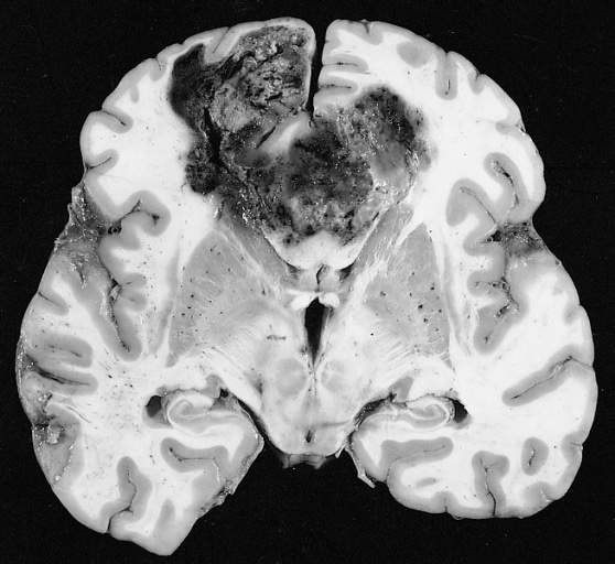Untreated glioblastoma with "butterfly" configuration/The Armed Forces Institute of Pathology 