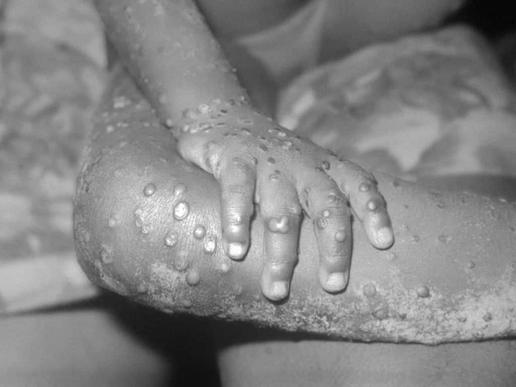 Monkeypox lesions on the right hand and leg of a child