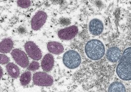 Monkeypox virus particles as seen through an electron microscope